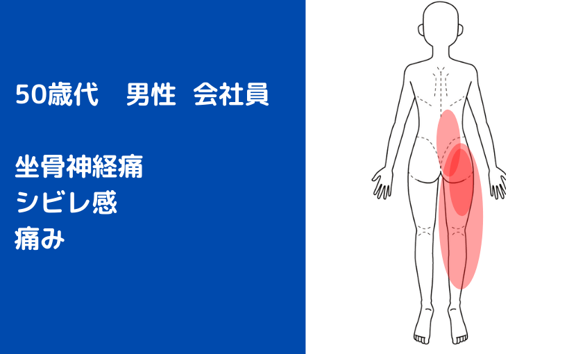 坐骨神経痛が出てしまった50代 男性会社員の方が来院されました