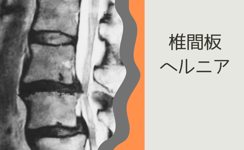 仙台の専門家が解説】椎間板ヘルニアと腰痛を手術なしで改善！カイロ